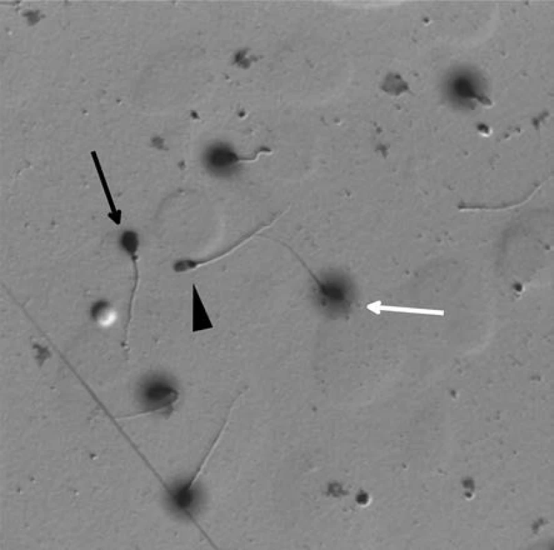 Spermie zpracované testem na disperzi chromatinu – Halosperm. Bílá šipka ukazuje zdravou spermii (H) s rozptýleným chromatinem kolem hlavičky („halo“ efekt), černá šipka ukazuje spermii s fragmentovanou DNA (F), černý trojúhelník spermii degenerovanou (D)
Fig. 2. Sperm processed by chromatin dispersion assay (Halosperm). The white arrow indicates healthy sperm (H) with a dispersed chromatin around the head („halo“ effect), the black arrow indicates the sperm with fragmented DNA (F) and the black triangle shows the degenerated sperm (D)