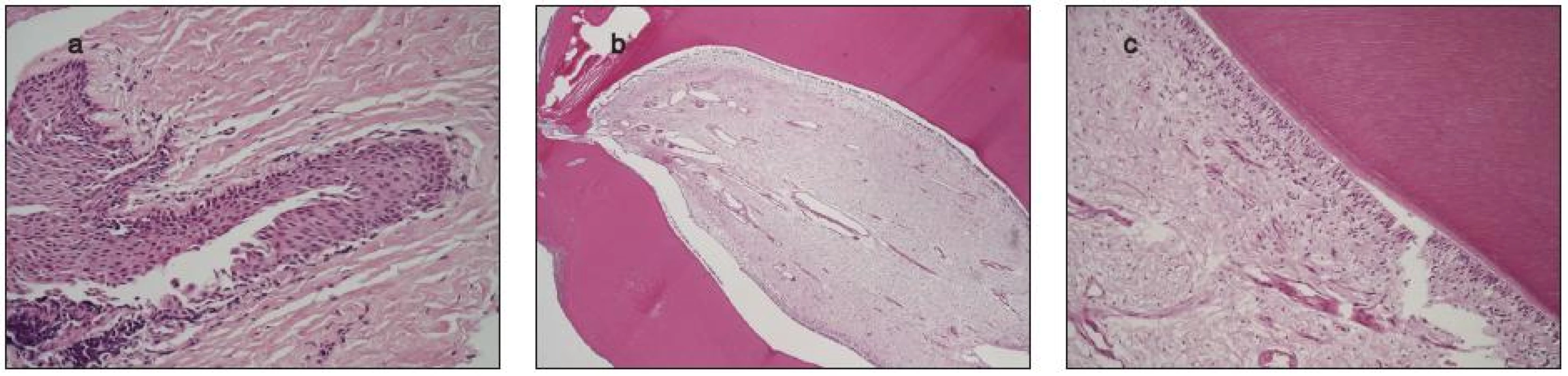 Histologický nález dentálnych štruktúr – 6a, b, c
6a – Cystický útvar s fibróznym puzdrom je vystlaný nerohovatejúcim dlaždicovým epitelom
6b – Súčasťou cystickej dutiny je útvar pripominajúci zub, tvorený dentínom a pulpou z cievnatého fibrózneho tkaniva. Od dentínu oddeľuje pulpu vrstva cylindrického epitelu
6c – Cylindrický epitel oddeľujúci dentín od pulpy má svetlú cytoplazmu s jadrami uloženými v rôznej výške .Farbenie-Hematoxylín a eozín, 25x, 100x