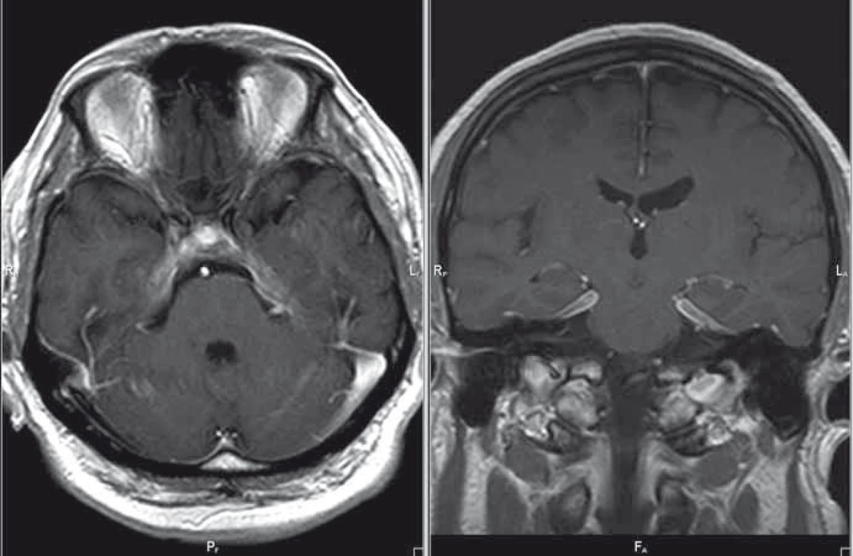 MR mozku, postkontrastní T1 vážené obrazy v axiální/koronární rovině; regrese nálezu – kazuistika 1.
Fig. 3. Brain MRI, contrast-enhanced T1-weighted images in the axial/coronal plane; disease regression – a case report 1.