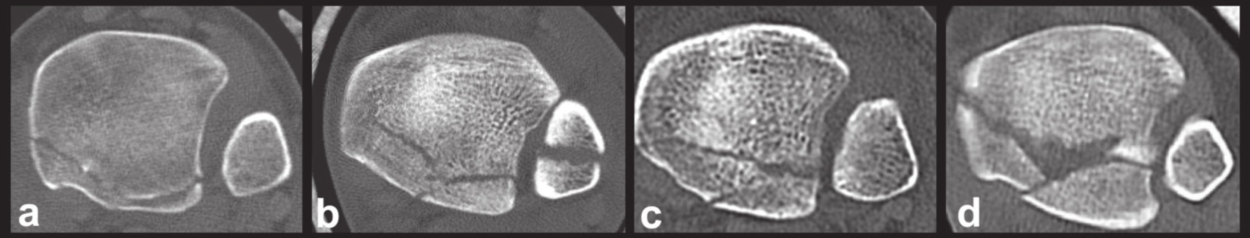 Variabilita typu 3 (dvoufragmentový typ) na transverzálních CT řezech
Obrázky a, b, c, d ukazují různou velikost fragmentů, různých rozsah postižení incisura fibularis tibiae a mediálního kotníku.
Fig. 13: Variability of type 3 (two-part fragment) on transverse CT scans
Figures a, b, c, d demonstrate variable size of fragments, variable involvement of the fibular notch and medial malleolus.