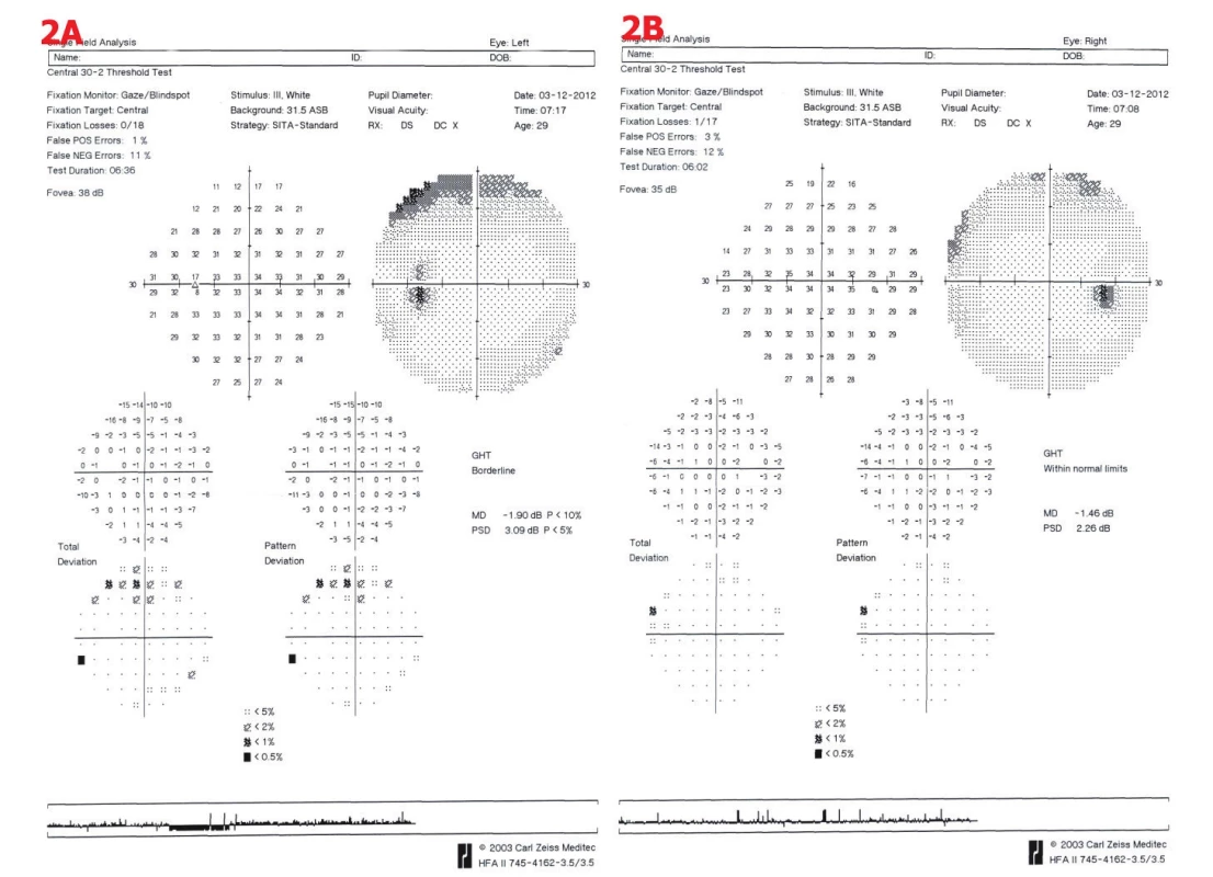 Perimetrické vyšetření u pacientky č. 2. 2A – OL – náznak horního arkuátního skotomu, 2B – OP – drobné relativní horní skotomy