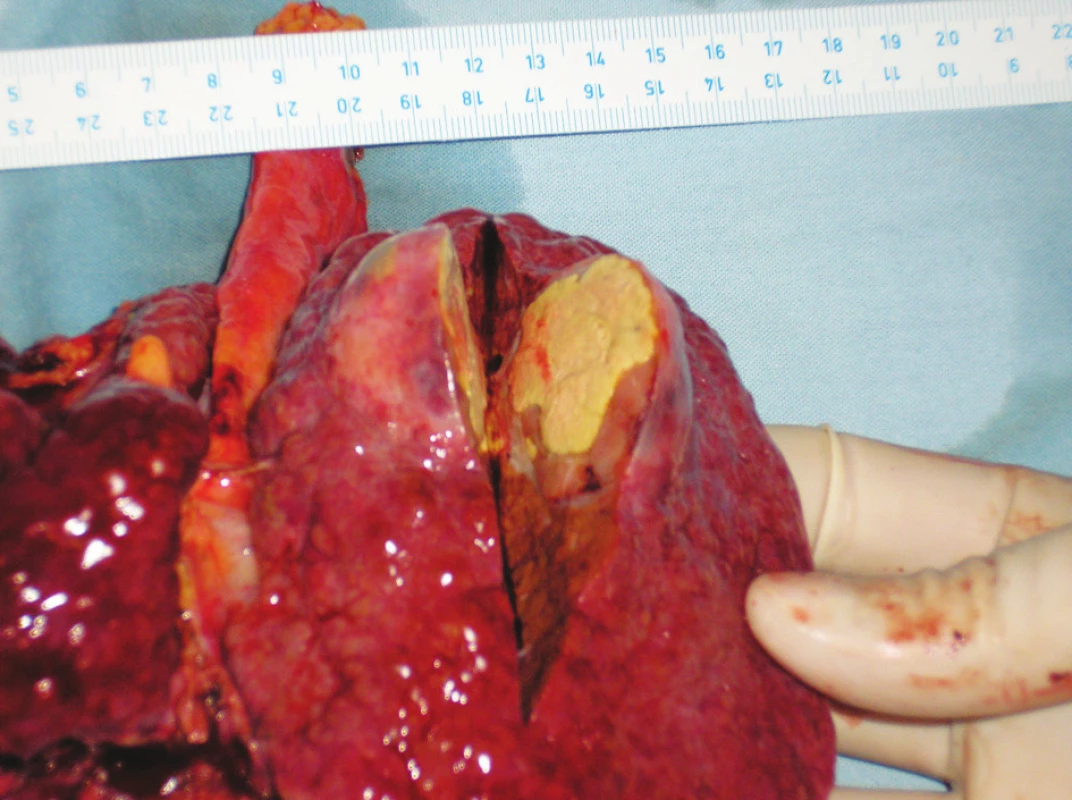 Nekrotický nádor – makroskopie
Fig. 6. The necrotic tumor – macroscopy