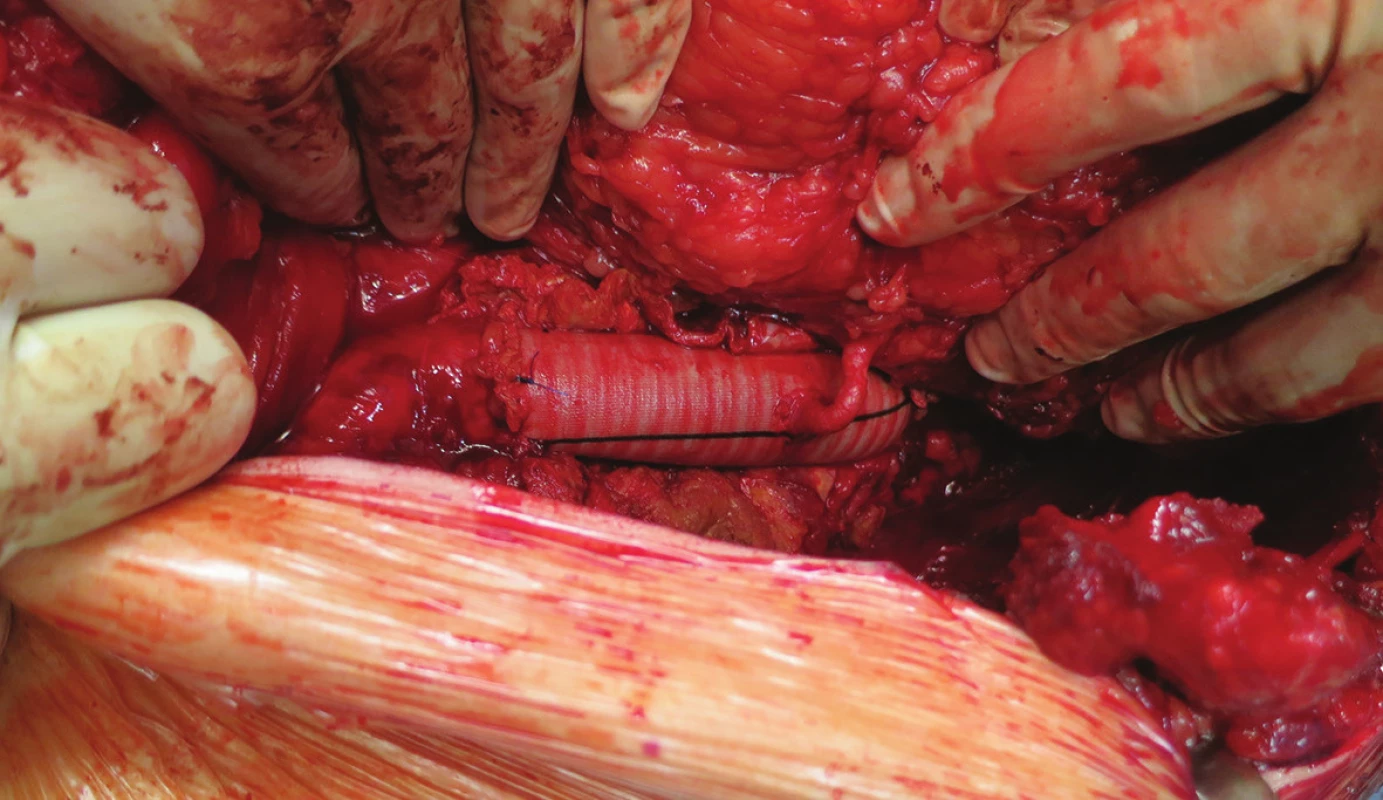 Náhrada s implantací levé renální tepny
Fig. 3: Aortic replacement with left renal artery implantation
