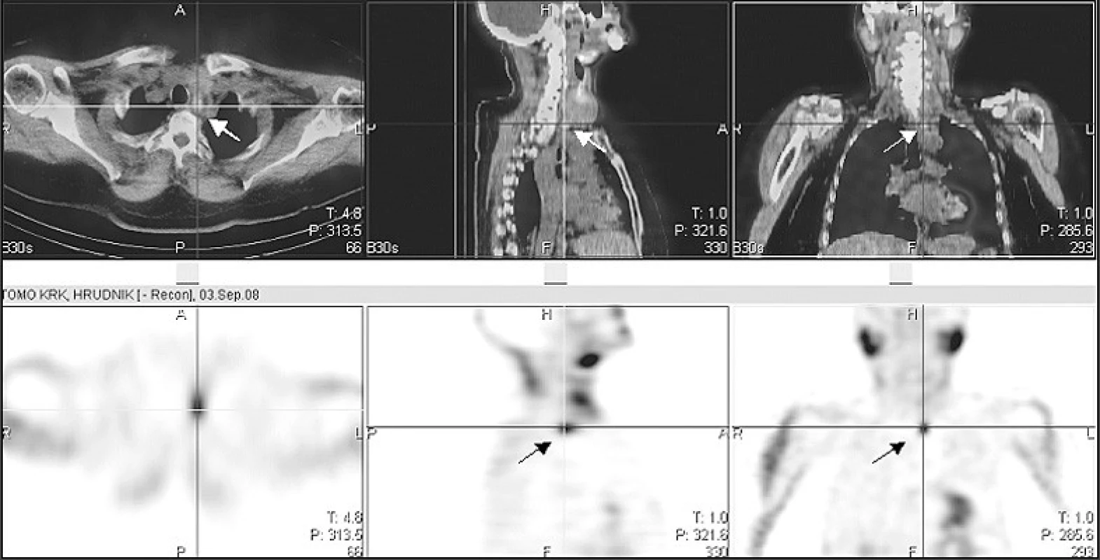 Scintigrafie příštítných tělísek doplněná tomografií krku a hrudníku (SPECT/low dose CT)
Drobné oválné ložisko zvýšené akumulace radiofarmaka (&lt;sup&gt;99m&lt;/sup&gt;Tc-MIBI) za dolním polem zvětšeného levého laloku štítnice hluboko prevertebrálně (šipka)