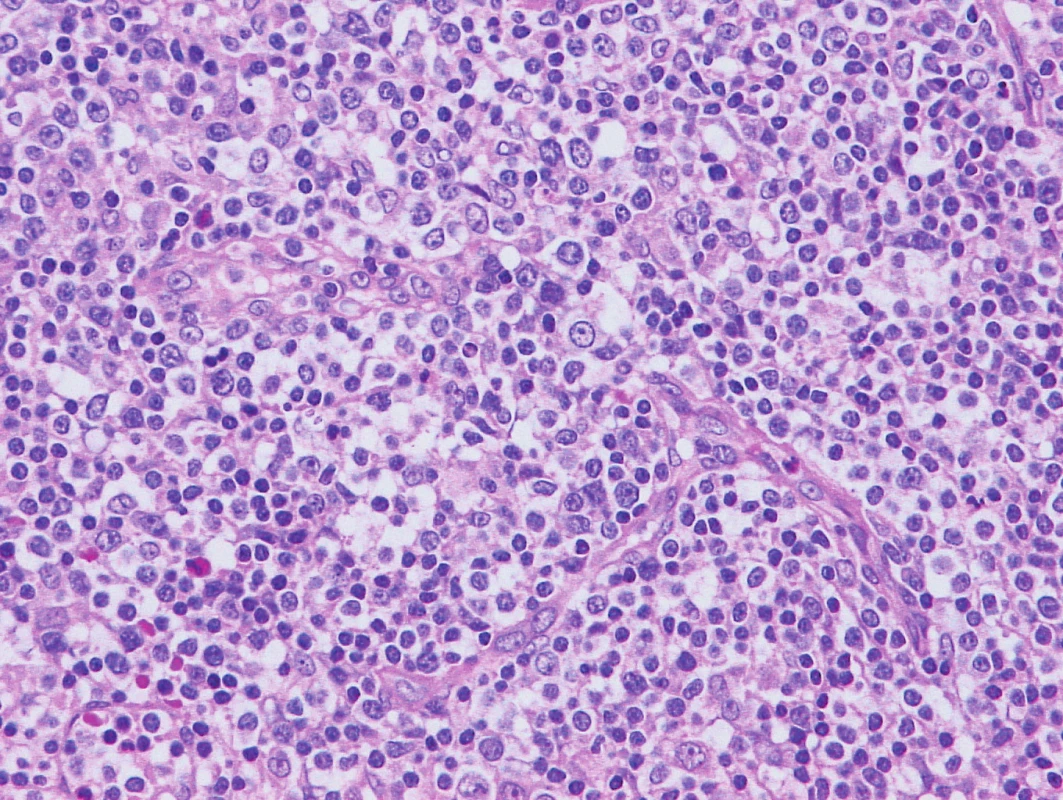 Vzorek z 1. bioptického odběru z roku 2013 – AITL 
Barvení hematoxylin-eozin. V okolí proliferujících cév patrna nádorová infiltrace ze středně velkých nádorových buněk, někdy s mírnými atypiemi, často se světlejší plazmou, fokálně příměs eozinofilů.