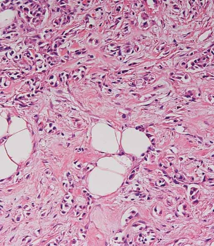 HE – karcinom blíže neurčeného typu G2–3 v punkční biopsii mammárního ložiska.