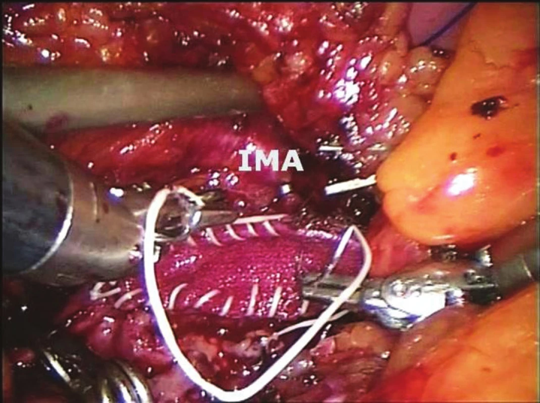 Tromboendarterektomie aorty se záplatou (IMA – arteria mesenterica inferior)
Fig. 2: Aortic thromboendarterectomy with prothetic patch (IMA – inferior mesenteric artery)