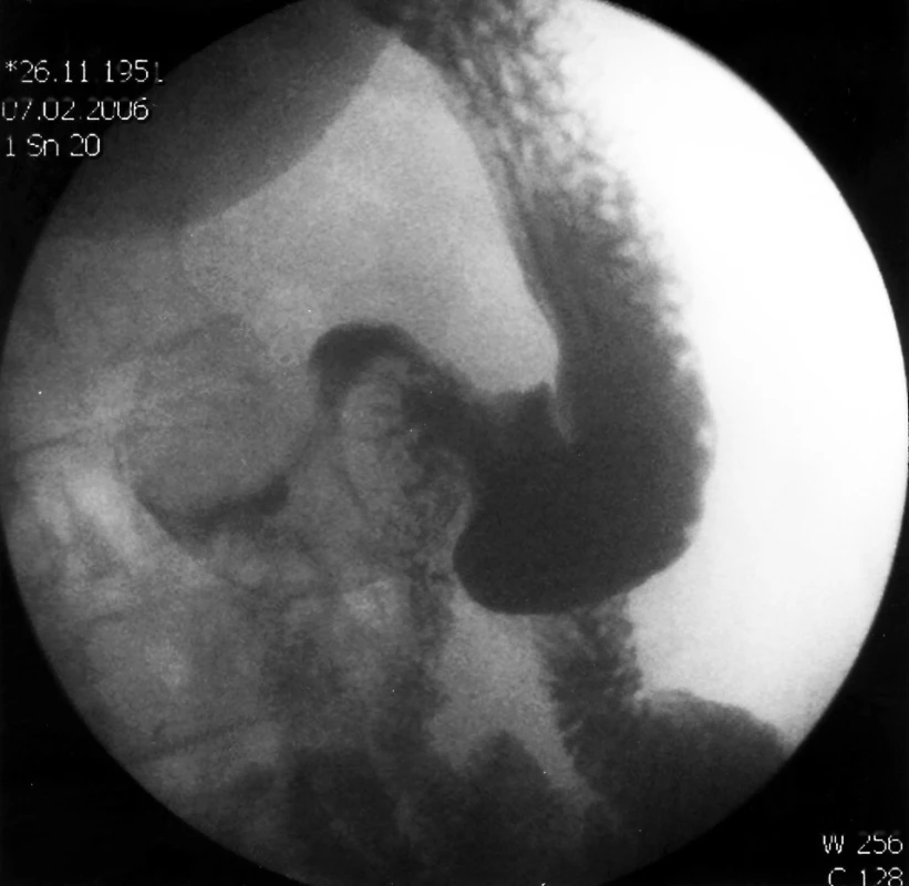 RTG kontrastní vyšetření zobrazující intraluminálně uložený objemný tumor duodena.
Pic. 2. Duodenography showing a large intraluminal tumour