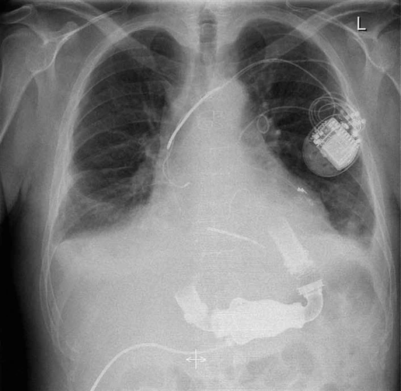Rentgenový snímek hrudníku pacienta s implantovaným HeartMate II&lt;sup&gt;®&lt;/sup&gt; LVAD a kardiostimulátorem (archiv KC IKEM).