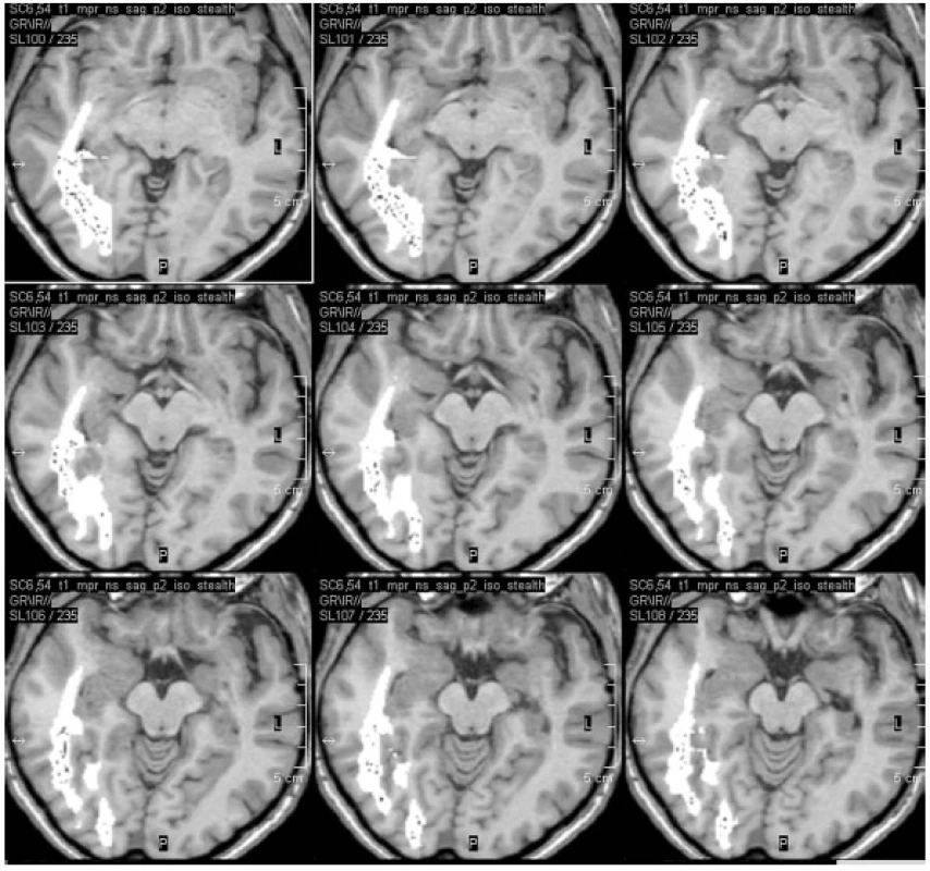 Fúze optické traktografie do neuronavigačního vyšetření před pravostrannou ATL