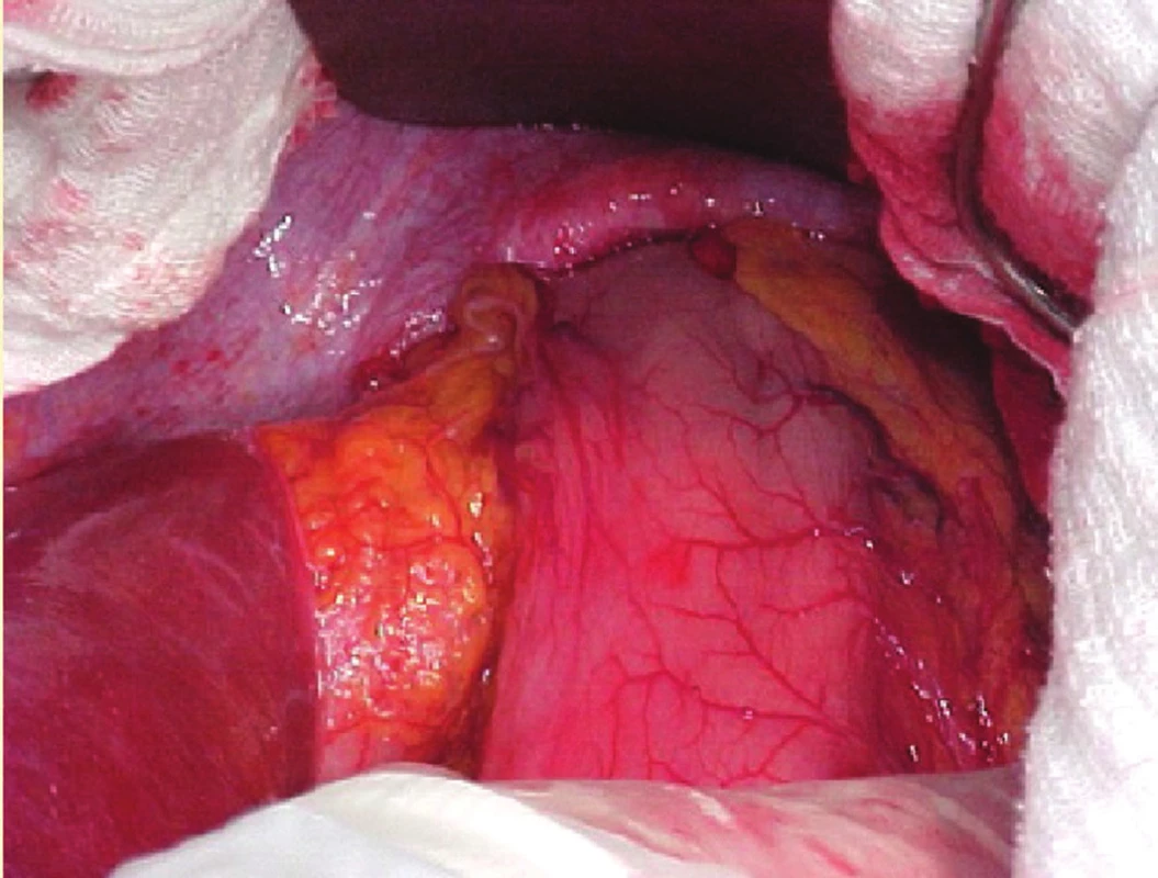 Levostranná ruptura bránice, žaludek v hrudníku – operační pohled
Fig. 1: Left-sided traumatic rupture of the diaphragm; stomach in the pleural cavity – view before surgical repair