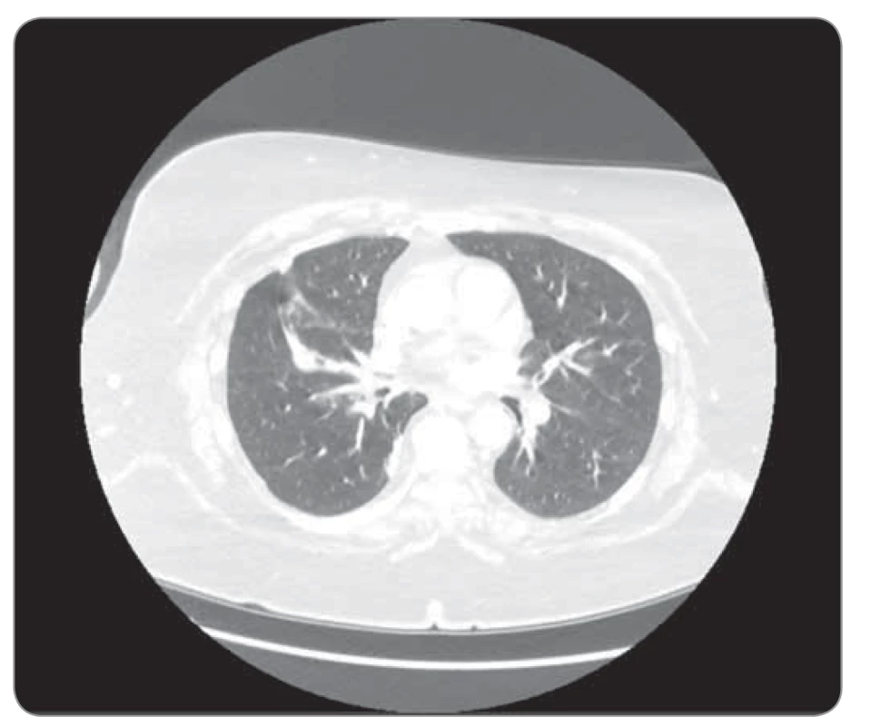 Kazuistika 2, CT hrudníku 6/2019 (před zahájením léčby).
©FNOL 2019.<br>
CT – výpočetní tomografie