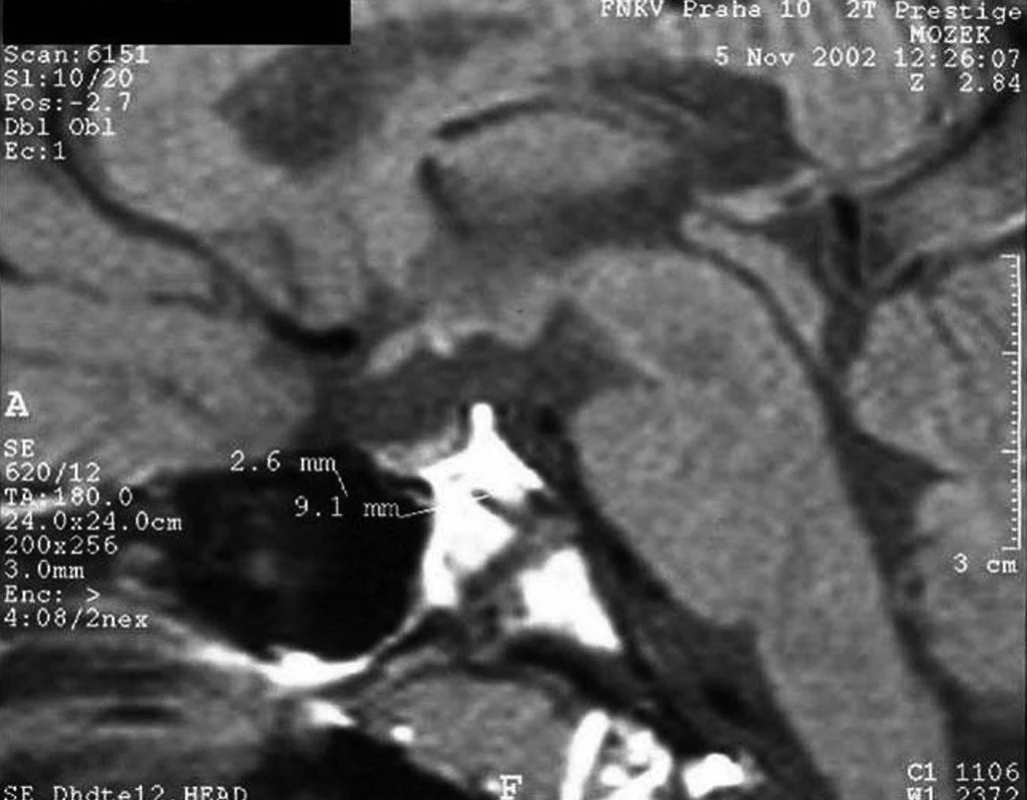 MRI obraz „ektopické neurohypofýzy“ u 14letého chlapce, který se narodil koncem pánevním a má kombinovaný deficit hypofyzárních hormonů. Hypofýza je hypoplastická (výška 2,6 mm, šířka 9,1 mm) a v typické lokalizaci chybí signál neurohypofýzy (hypersignální světlá skvrna). Světlou skvrnu lze identifikovat ektopicky – v místě obvyklého odstupu stopky hypofýzy, kde po přerušení stopky došlo k novému zformování axonálních zakončení hypotalamických sekrečních neuronů. V tomto místě se vydává do krve antidiuretický hormon.
