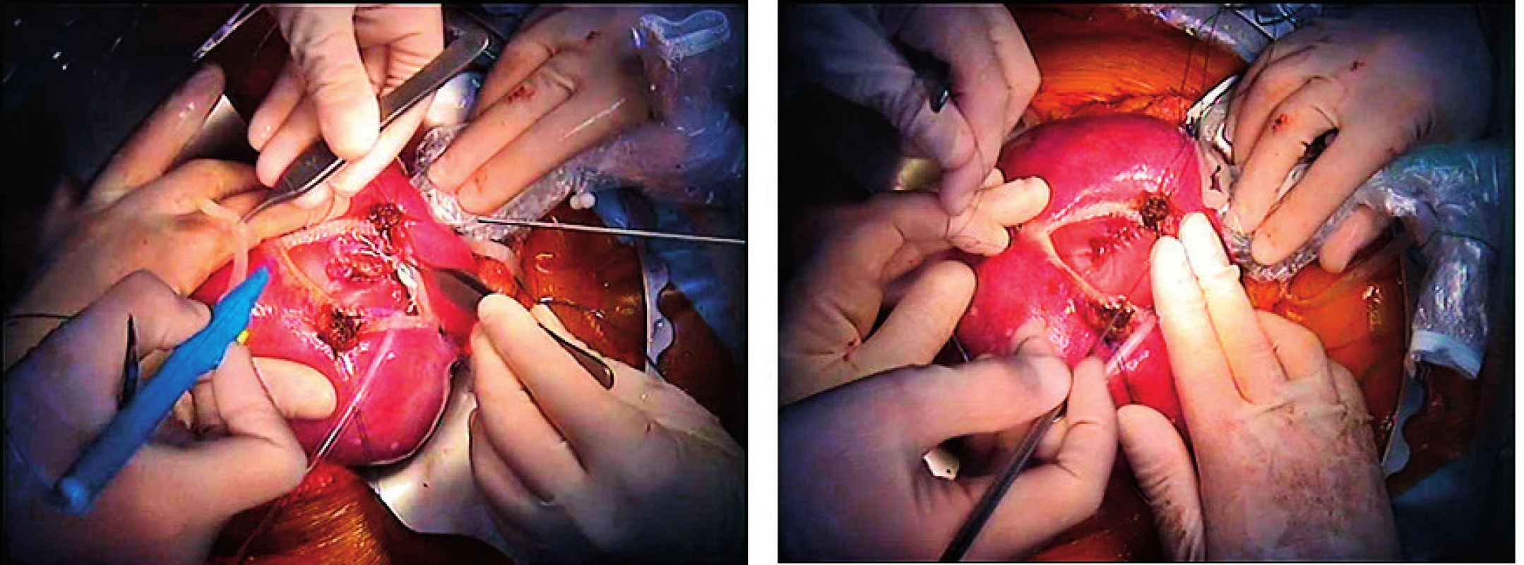 Operace plodu s lumbo-sakrální meningomyelokélou (vlevo) s uzavřením defektu in utero (vpravo). Operace byla provedena v KU Hospital Leuven, prenatální, perinatální a neonatální péče poskytována v ÚPMD (foto archiv ÚPMD)