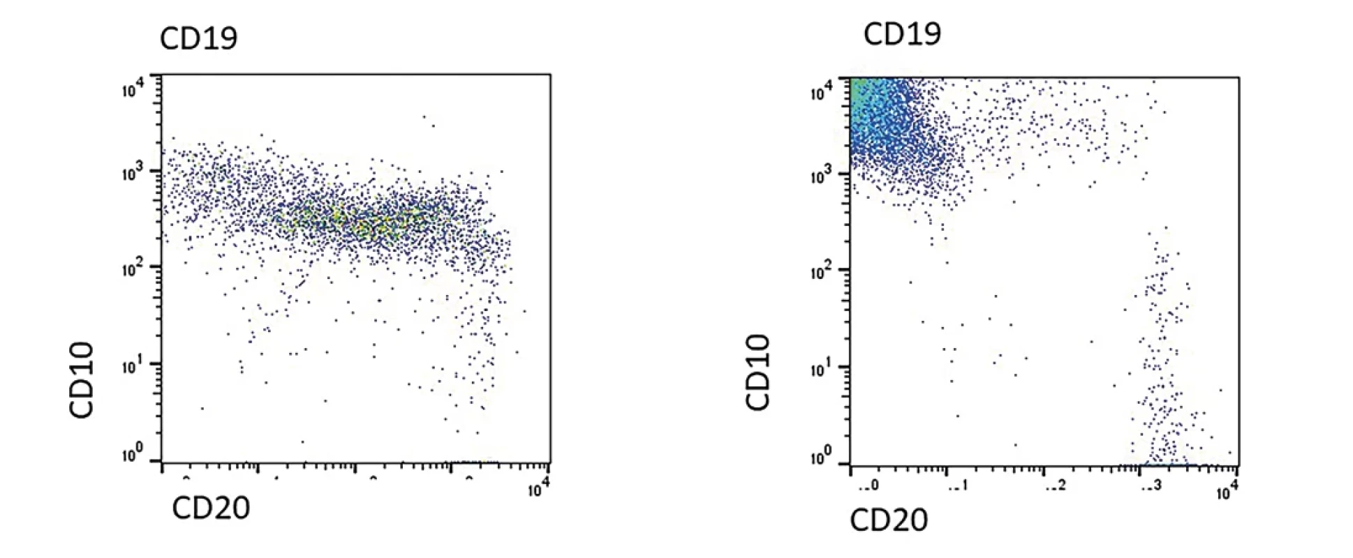 Na obrázku A je zobrazen nález u 14 denního novorozence s čilou regenerující nemaligní B řadou. Je zřetelná diferenciace dle antigenu CD10 a CD20. Vpravo na obrázku B je pacient s BCP ALL, u kterého je zřetelná hyperexprese antigenu CD10.