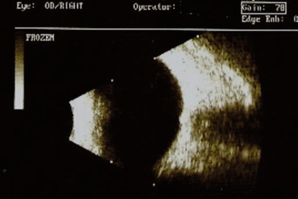B-scan ultrazvukové vyšetrenie pravé oko (pacient č. 1).
Na úrovni TZN viditeľné hyperechogénne útvary – drúzy.