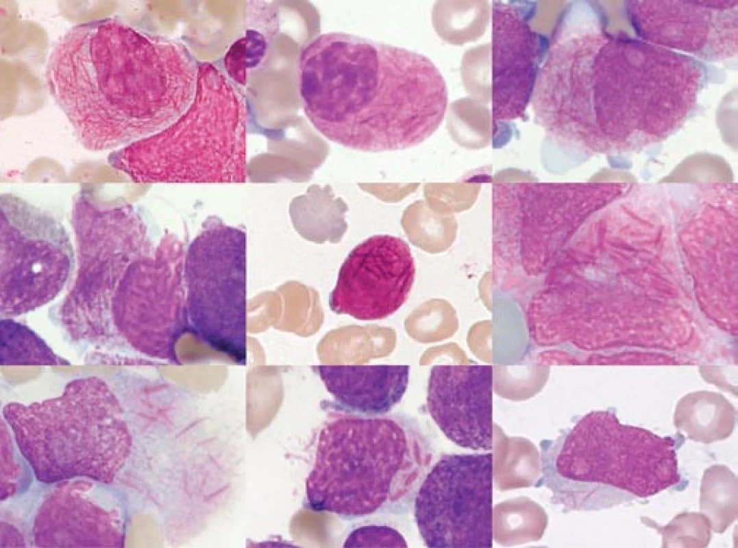 „Faggot cells“ různých pacientů. Obrázek ukazuje morfologickou variabilitu různých „faggot cells“.
