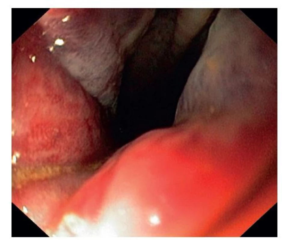 Obr. 3: Sigmoideoskopie s prokrvácenými hemoroidy a ascaridou
Fig. 3: Sigmoideoscopy with haemmatose haemmoroids and pinworm