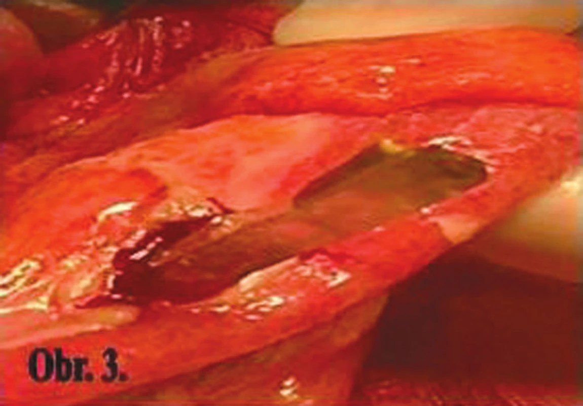 Perforačný otvor na sigme
Fig. 3: Perforation hole in the sigmoid colon
