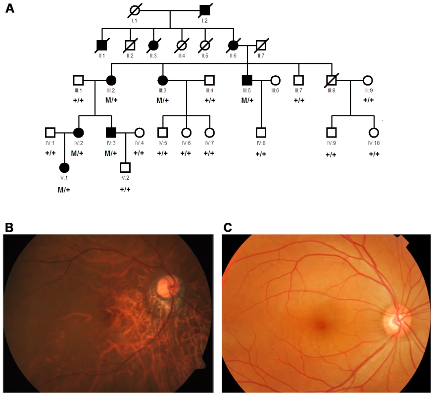 Pedigree and segregation of the mutation and fundus photograph of a patient from the family.