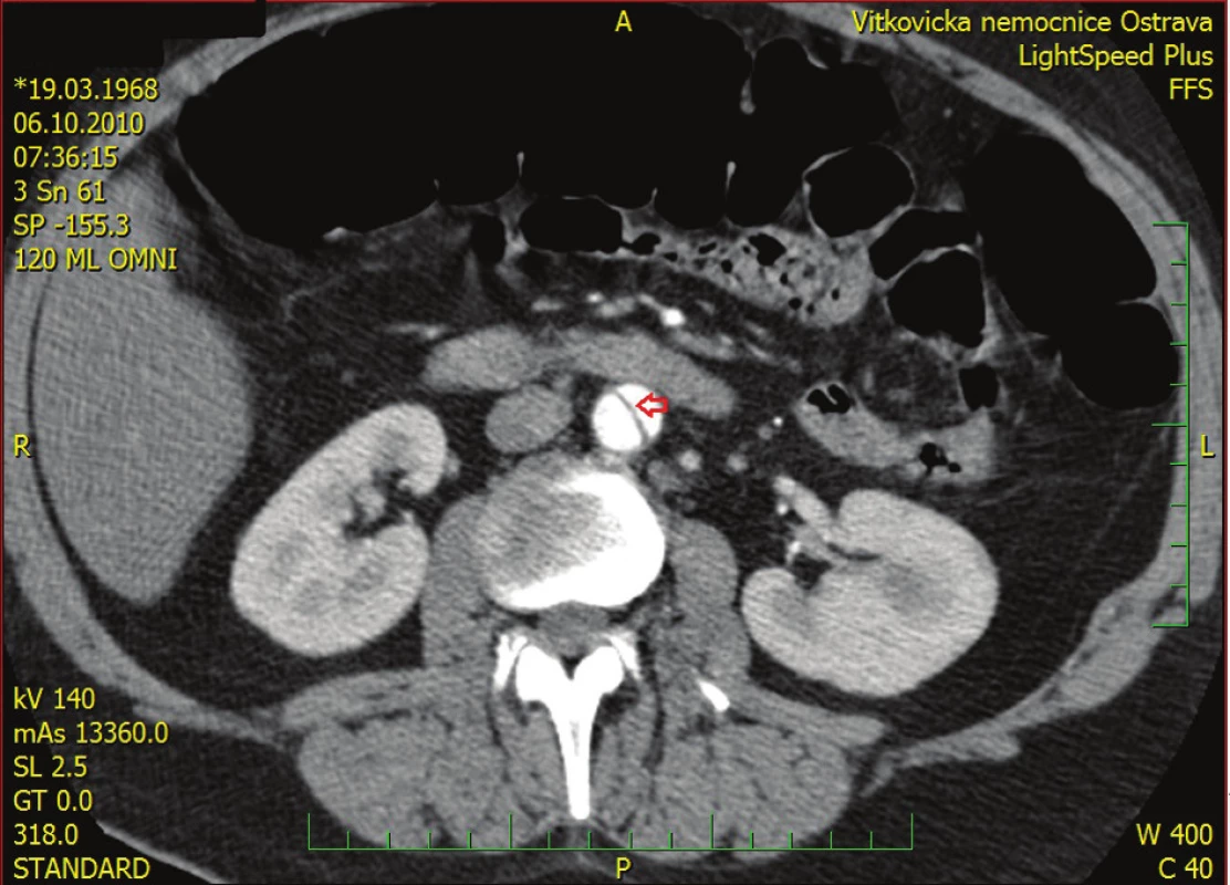 CT sken s obrazem dvojitého lumen aorty Červená šipka ukazuje odchlípnutý endotel.
Fig. 3: CT scan showing double-barrel dissected abdominal aorta Red arrow indicates the intimal flap