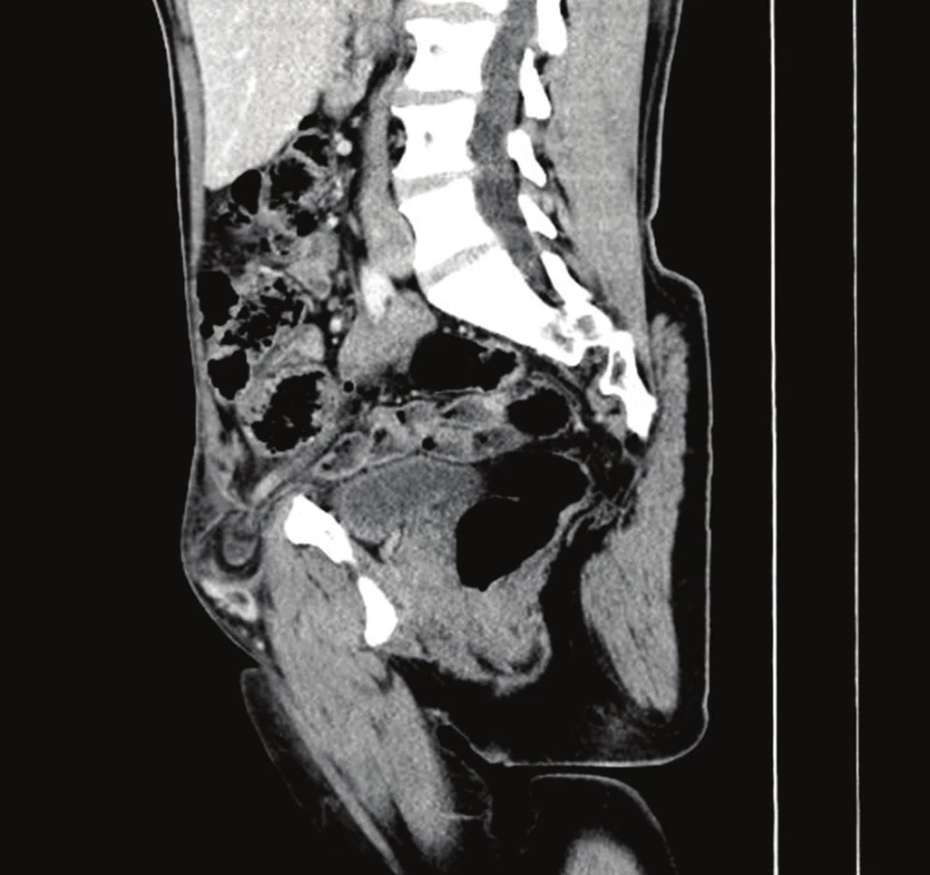 CT nález – femorální hernie s inkarcerovaným apendixem
Fig. 1: CT findings – incarcerated femoral hernia with appendix