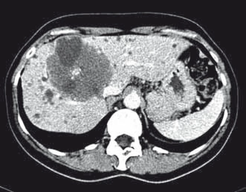 CT s kontrastom – axiálne zobrazenie. Prítomnosť rozsiahlej echinokokovej cysty v pečeni.
Fig. 1. CT scan with contrast. Axial image. Presence of extensive hydatid cyst in the liver.