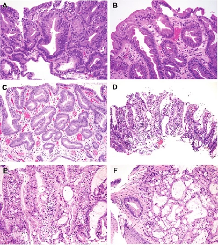 A. This “nonadenomatous” dysplasia contains glands with serrated contours, as do [H&amp;E (100x)] (B) intestinal and [H&amp;E (100x)] (C) pyloric/cardiac dysplasia in some instances. We have encountered a singular case that would appear to show [H&amp;E (100x)] (D) [H&amp;E (40x)], (E) [H&amp;E (200x)] dysplasia and carcinoma (F) with a serrated appearance [H&amp;E (200x)].