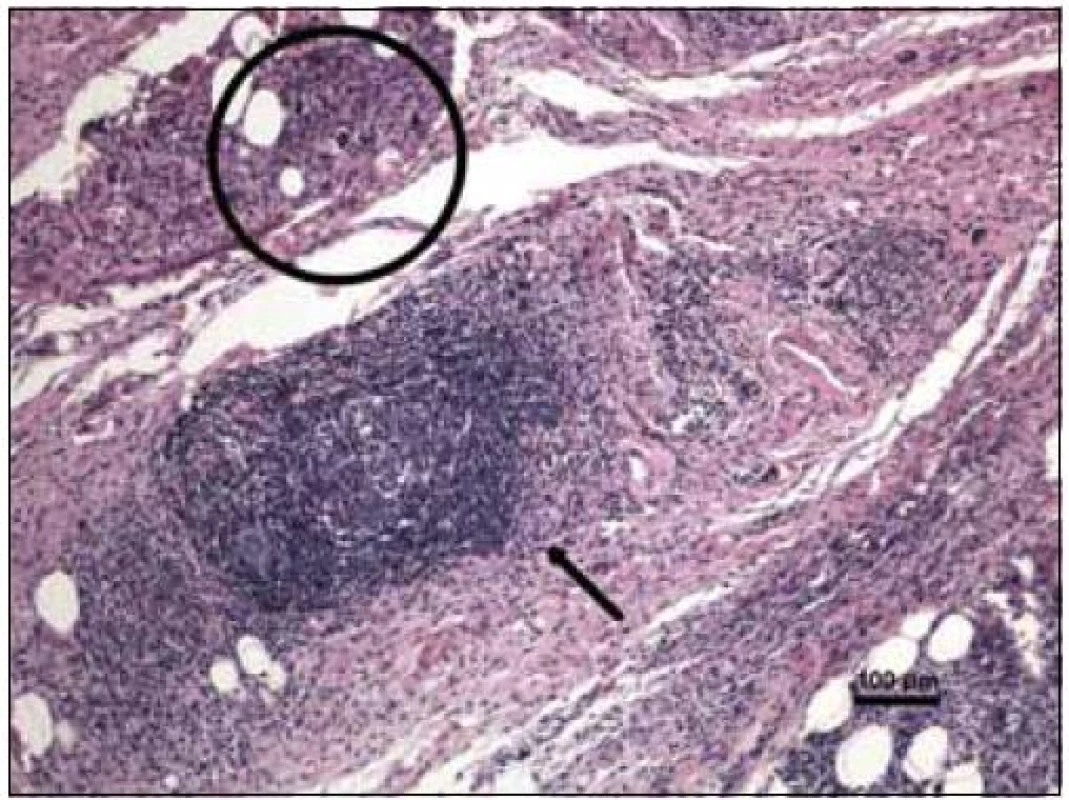 Barvení hematoxylin-eozin, původní zvětšení 100krát. Vazivově tuková tkáň očnice s převážně chronickou zánětlivou celulizací, místy s tvorbou lymfatických folikulů se zárodečnými centry (šipka). V jiných oblastech je zánětlivý infiltrát méně hustý. I při tomto relativně přehledném zvětšení jsou patrné obrovské mnohojaderné buňky Toutonova typu (v kružnici).