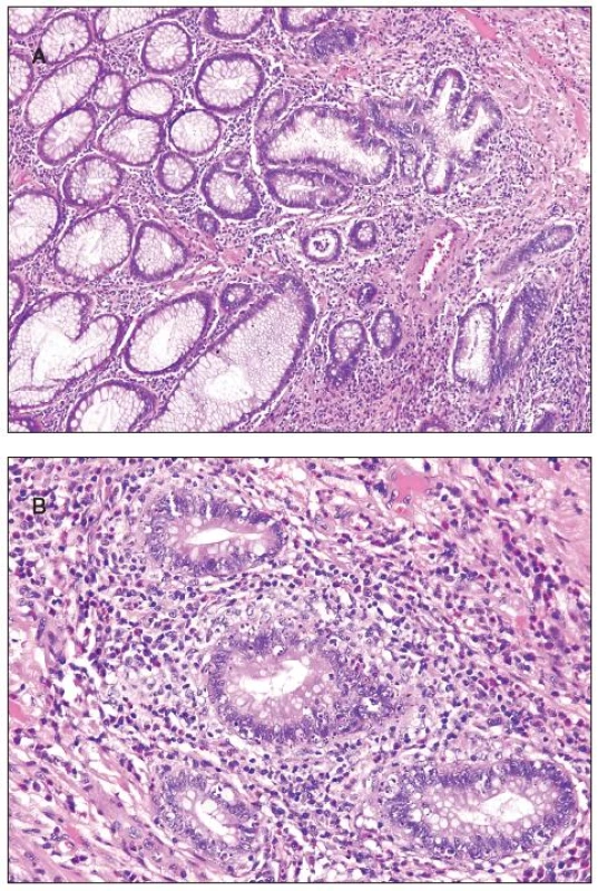 Inflammatory pseudopolyp, A - low power view with focus of cryptitis (in the center of the photomicrograph); B - increased apoptosis of the crypt epithelium in the same pseudopolyp.