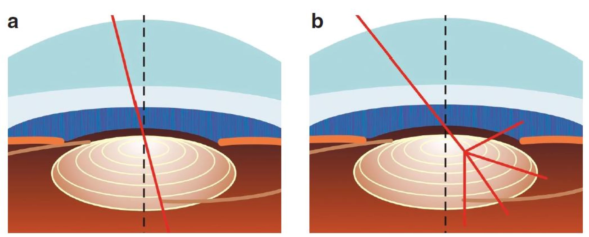 Při malém úhlu kappa prochází paprsek směřující do fovey přes centrální část čočky (a). Při velkém úhlu kappa prochází blíže hraně koncentrického prstence MIOL (b), což může způsobit výraznější fotické fenomény.