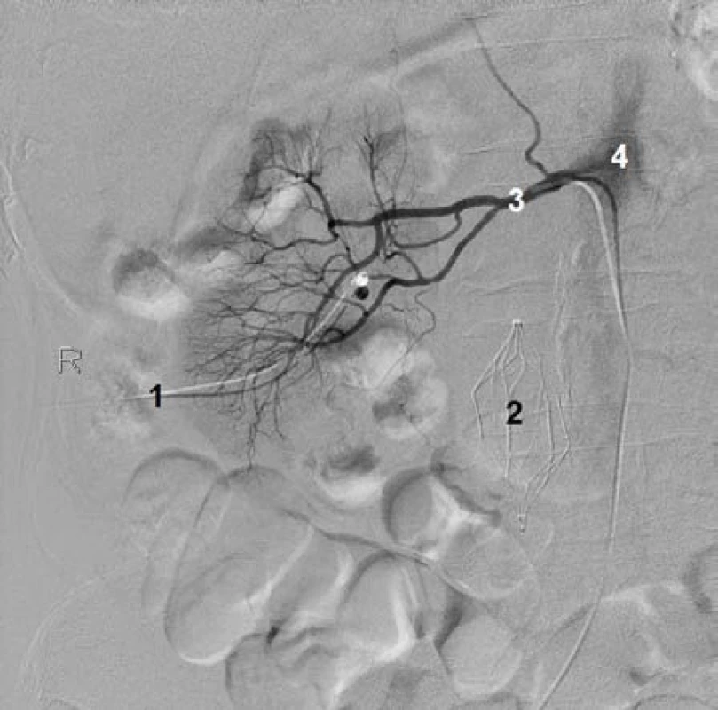 Angiografie pravé ledviny. 1) Nefrostomie, 2) kavální filtr v dolní duté žíle, 3) pravá renální arterie, 4) břišní aorta
Fig. 1 Angiography of right kidney. 1) Nephrostomy, 2) filter of inferior vena cava, 3) right renal artery, 4) abdominal aorta