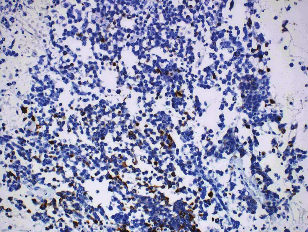 Focal expression of cytokeratin 18 in an undifferentiated component (original magnification 200x).