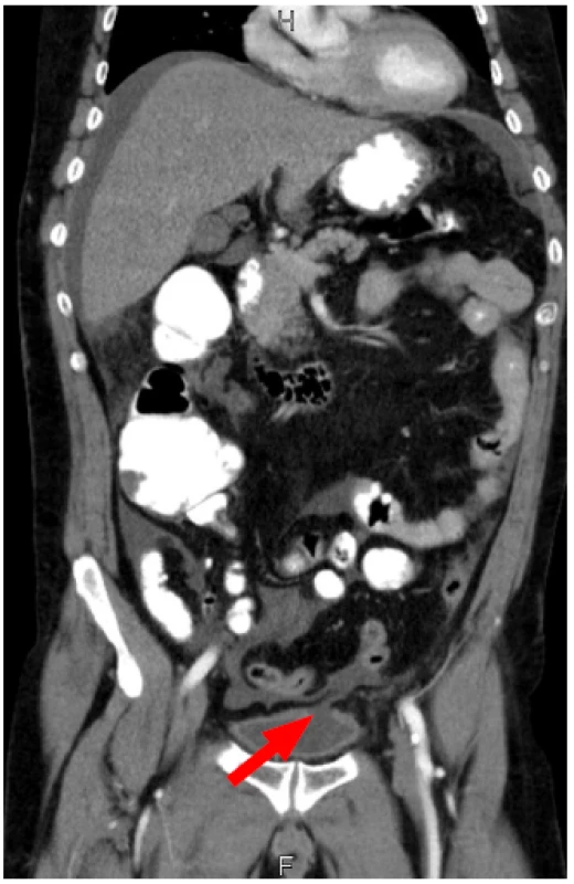 CT vyšetření: defekt stěny v oblasti vrcholu močového měchýře
Fig. 1 CT scan: defect of the bladder wall at the dome