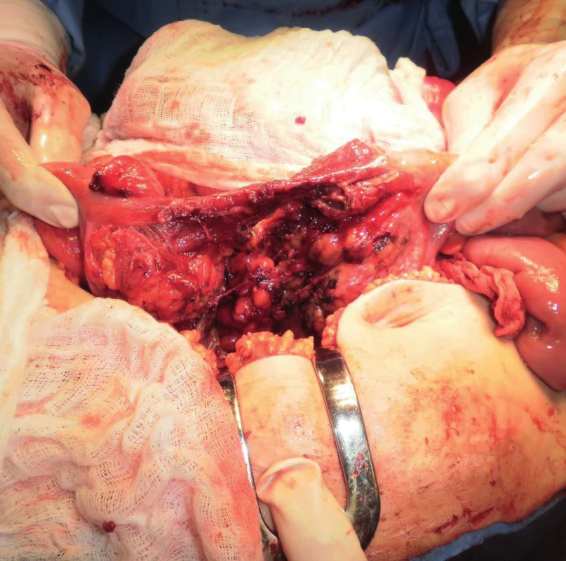Peroperační snímek ruptury tenkého střeva u tupého poranění břicha zraněného s polytraumatem