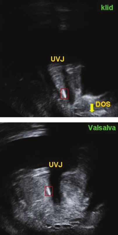 Introitální sonografie u pacientky ve 37. týdnu gravidity ukazuje normální pozici VVP (červený rámeček) v klidovém stavu i při Valsalvově manévru.&lt;br&gt;
UVJ – uretrovezikální junkce,&lt;br&gt;
DOS – dolní okraj symfýzy