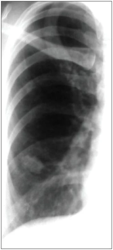 RTG snímek plic ze štítu (03/1987). Vpravo laterálně v parenchymu plicním ložisko indurace.