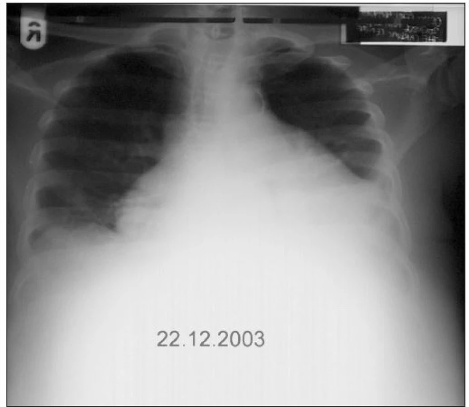 RTG srdce a plic (22. 12. 2003): Výrazné oboustranné rozšíření srdečního stínu, hrotem ke stěně hrudní, s menším bazálním výpotkem vlevo, plicní parenchym bez ložiskových změn, ateromatóza aorty.