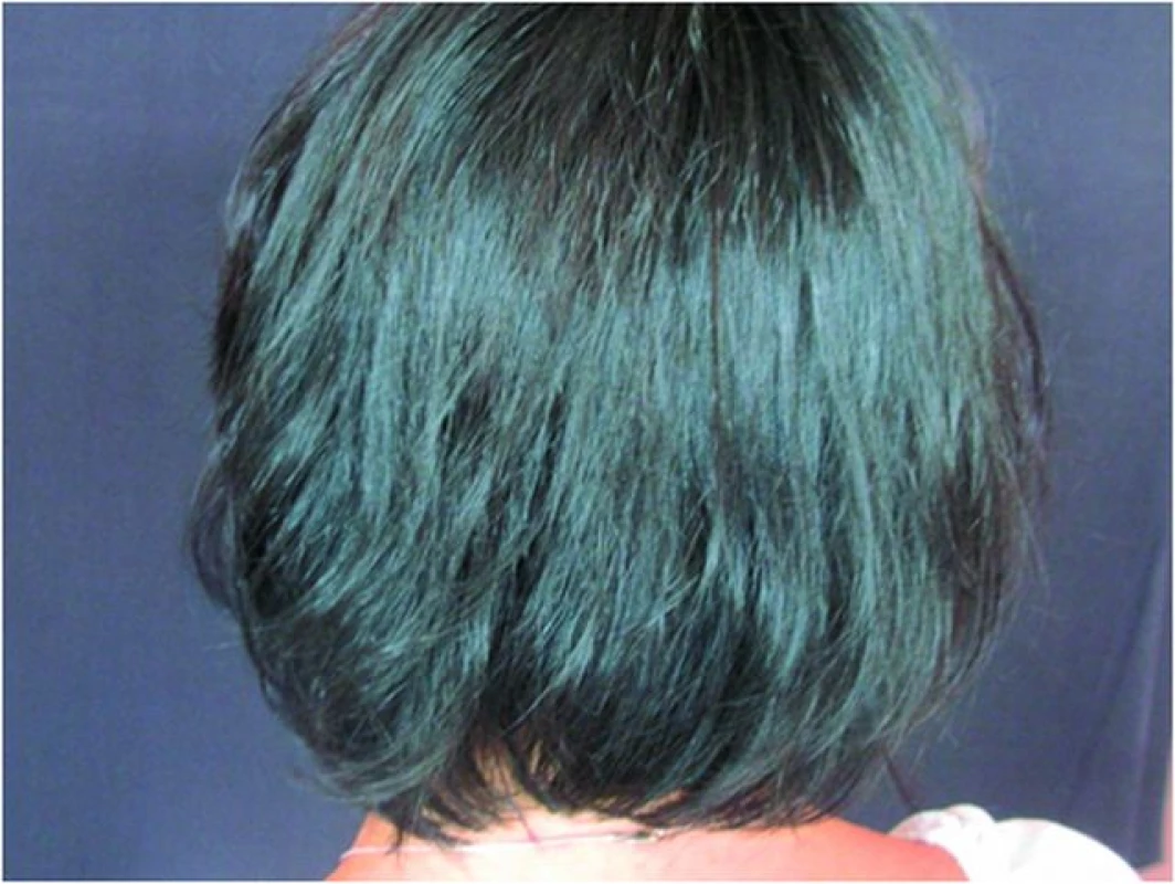 Alopecia areata – po léčbě (celkově kortikosteroidy, místně cygnolin)