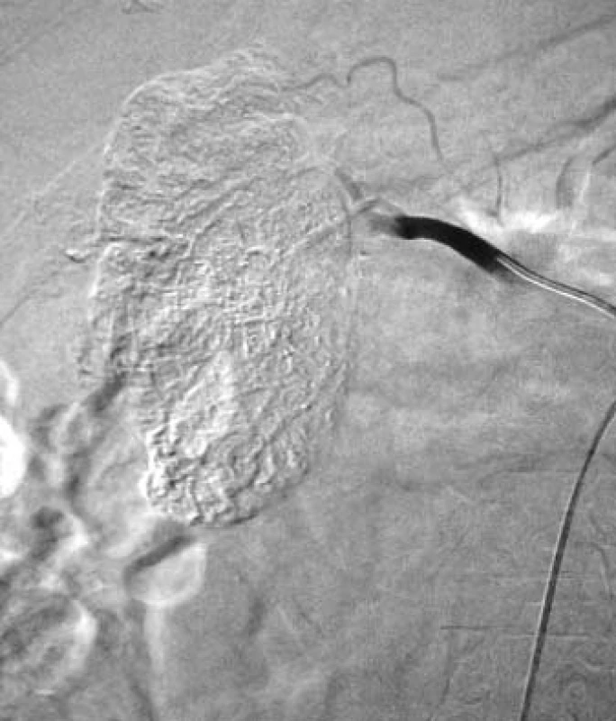 Kontrolní angiografie pravé renální tepny po embolizaci směsí spongostanové kaše a olejové kontrastní látky.