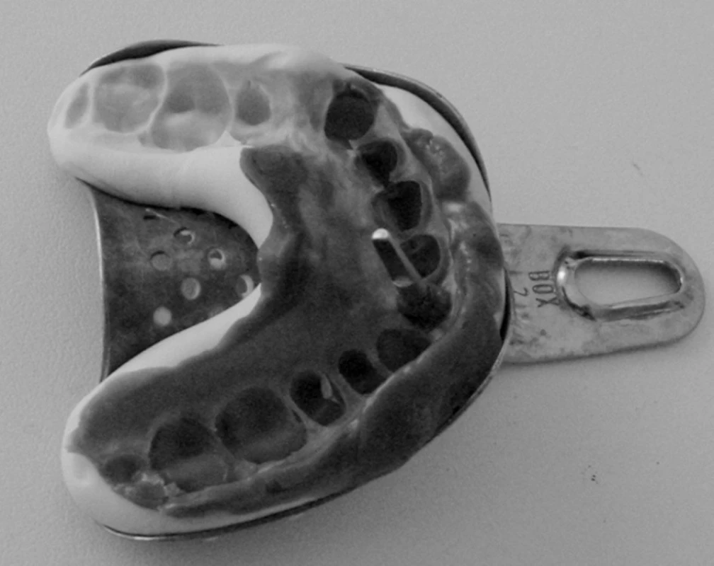 Otlačok zubného oblúka so vsadenou titanovou nadstavbou a laboratórnou replikou implantátu. (Foto: Eurodent medima, s.r.o.)
