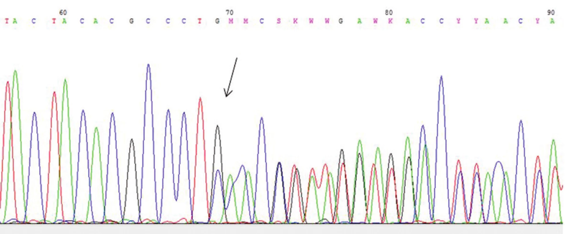 Gen COL5A1: mutace c. 1048insG v 7. exonu předčasný terminační kodon