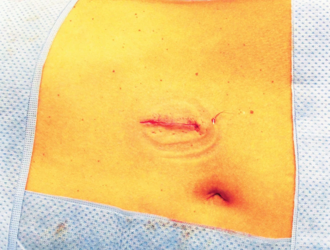 Břišní stěna po jednoportové laparoskopické (LESS) adremalektomii
Fig. 3. Abdominal wall after laparoscopic (LESS) adrenalectomy