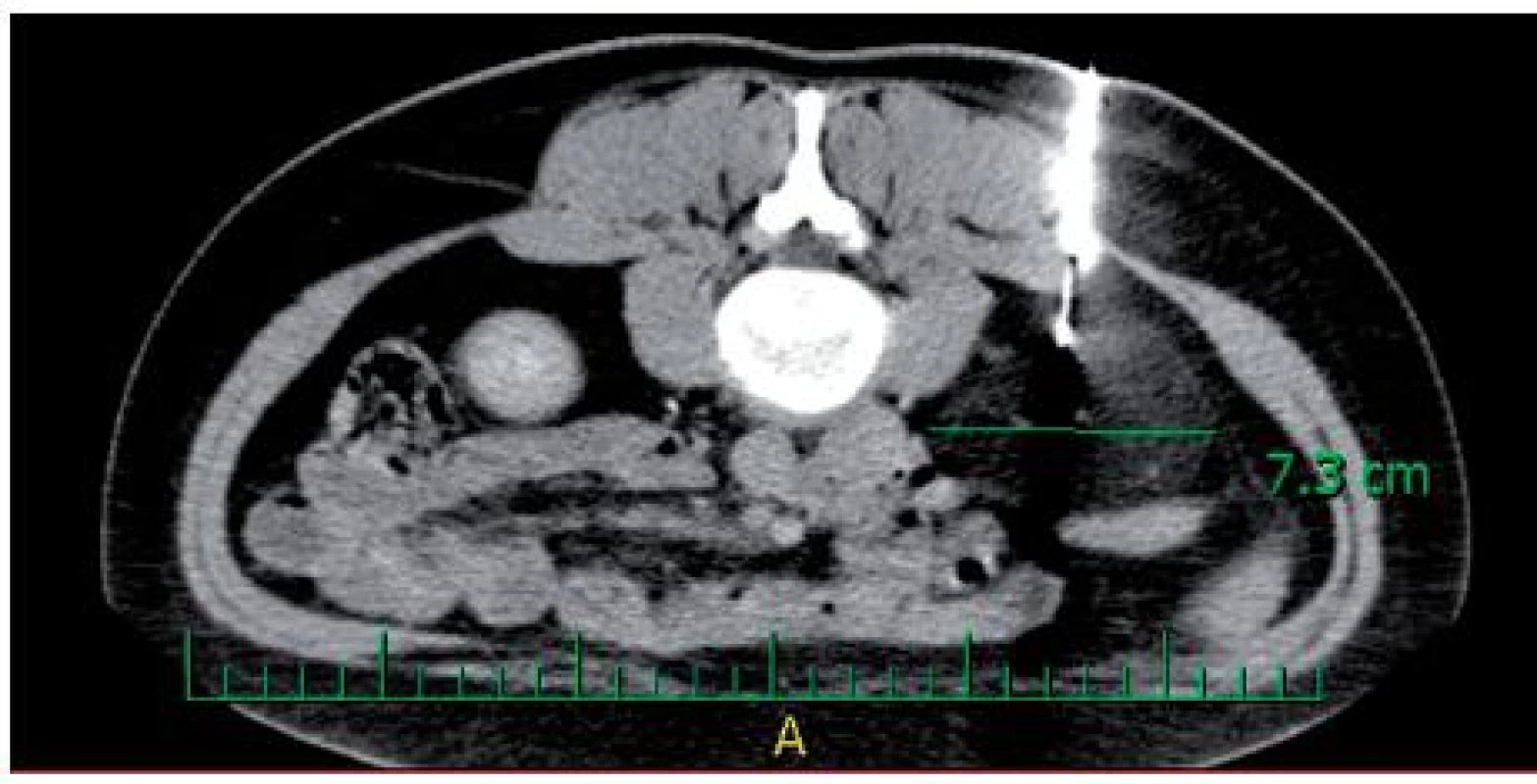 Biopsie tumoru pod CT
Fig. 2. Biopsy of tumour under CT control