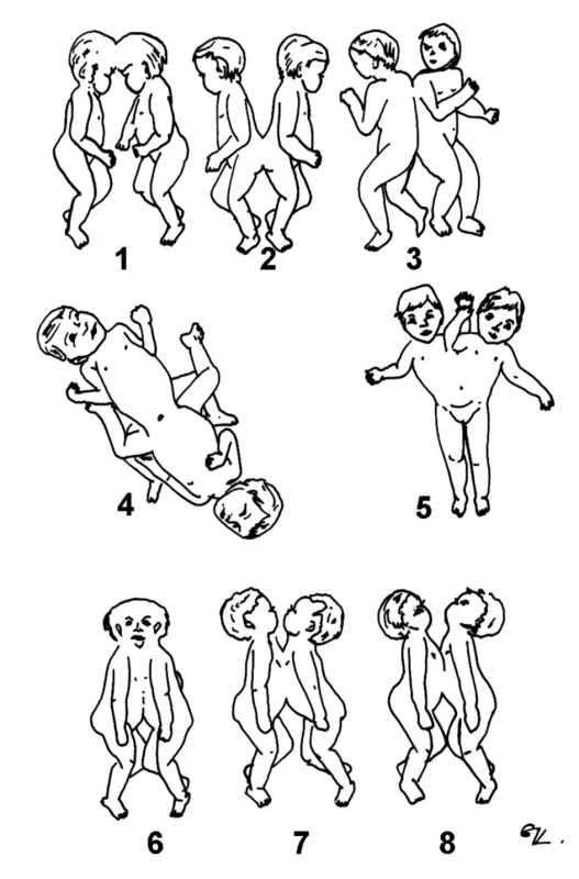 Anatomické znázornenie rôznych typov dvojčiat, upravené podľa Spencera [30].
Fig. 1. Anatomical representation of different types of twins, as modified according to Spencer
[30].
1 – craniopagus, 2 – pygopagus, 3 – rachipagus,
4 – ischiopagus, 5 – parapagus, 6 – cephalopagus,
7 – thoracopagus, 8 – omphalopagus