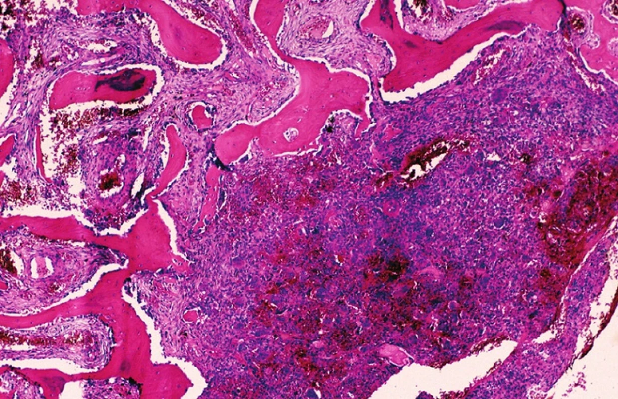 Centrální obrovskobuněčná léze čelisti tvořená vazivovou tkání s příměsí obrovských vícejaderných buněk typu osteoklastů především v místech hemoragií. V ohraničujícím vazivovém septu je nenádorová metaplastická osifikace. HE, x40.