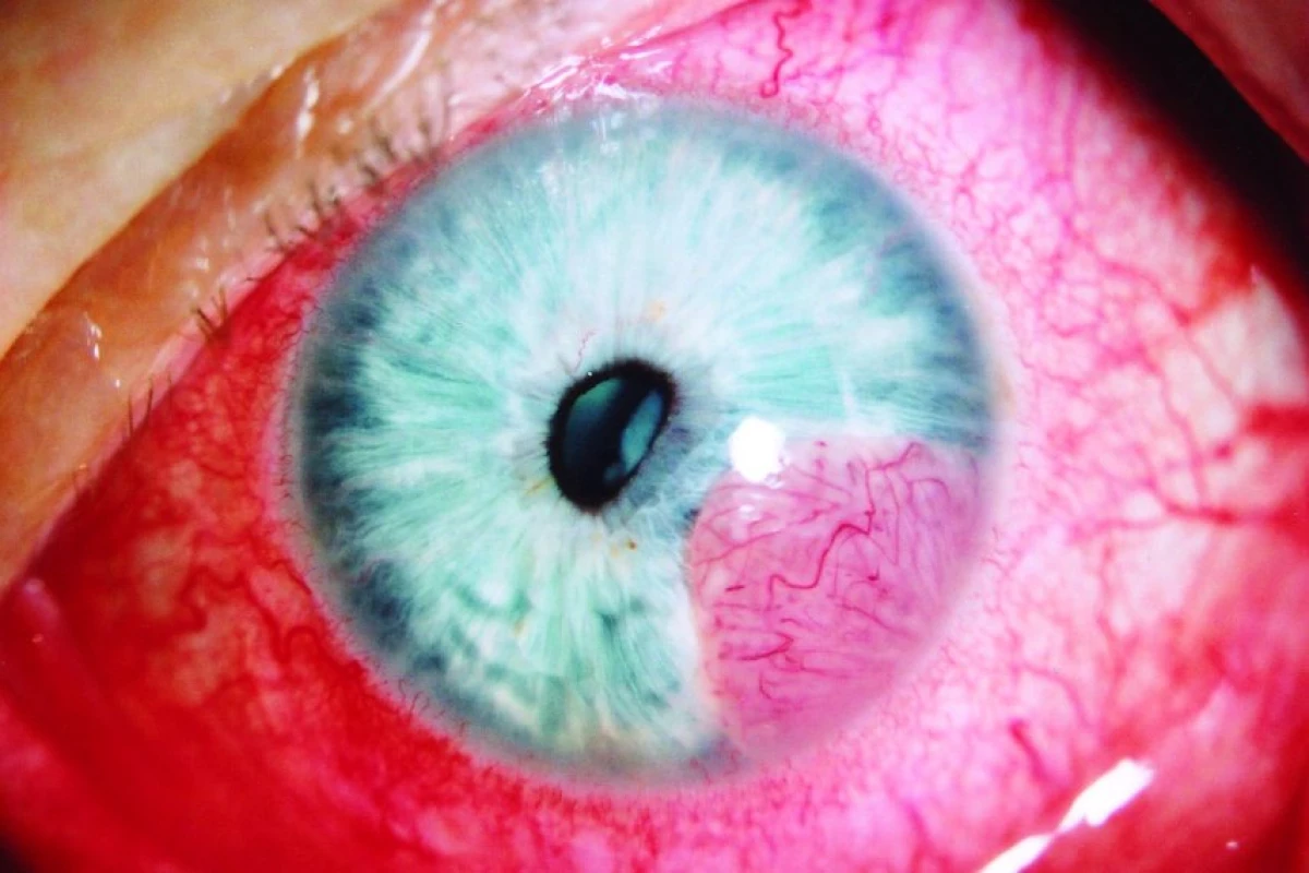Ložisková tumorózní infiltrace duhovky levého oka.