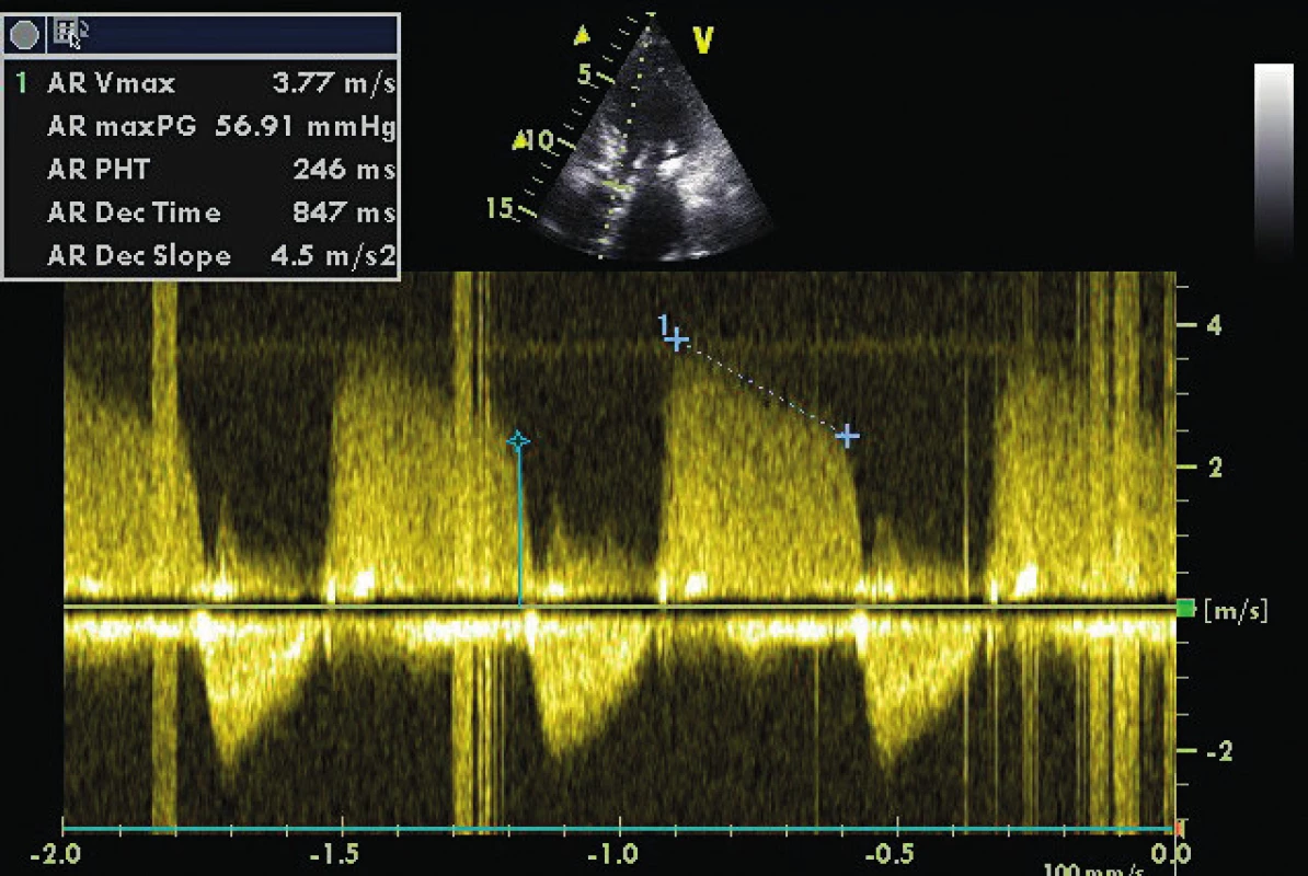 CW doppler v A5C u pacienta s těžkou AR (viz PHT 246 ms)