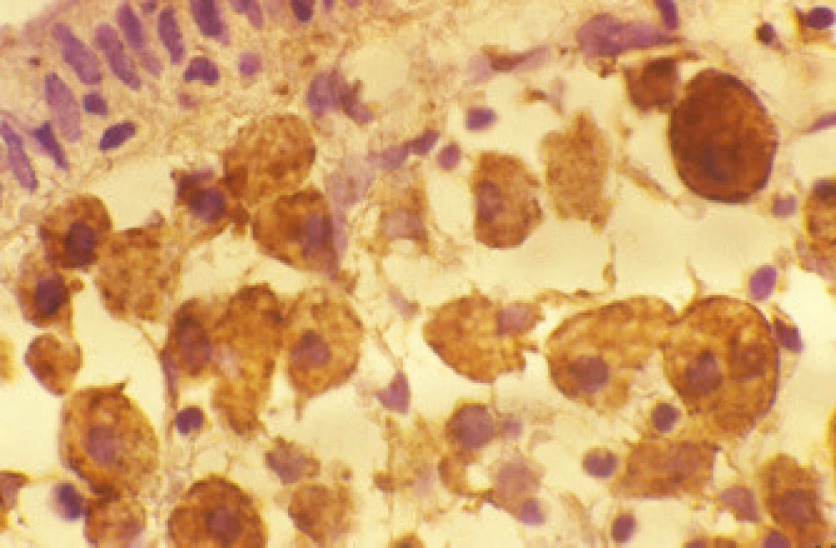 Whippleovy makrofágy obsahují účinné lyzozomální proteázy podílející se na likvidaci intracelulárních bakterií.
