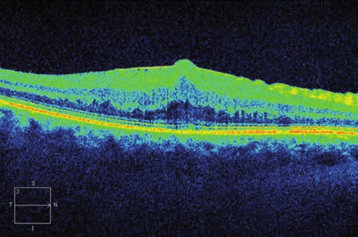Horizontální transfoveolární OCT sken, předoperační nález ERM na pravém oku